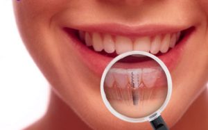 ایمپلنت و زندگی افسانه ای
